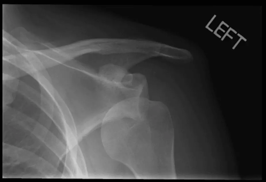 Xray result of a shoulder